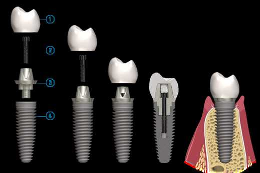 dental implant parts diagram