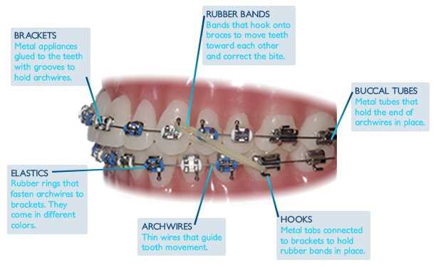 braces parts diagram